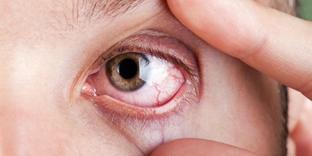 Đeo kính áp tròng sai cách có thể làm đỏ mắt