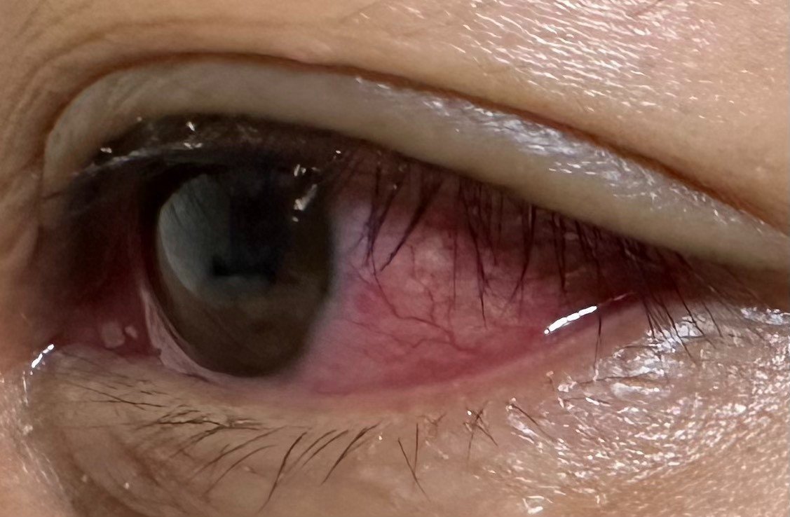 Đeo lens quá lâu có thể dẫn tới đỏ mắt